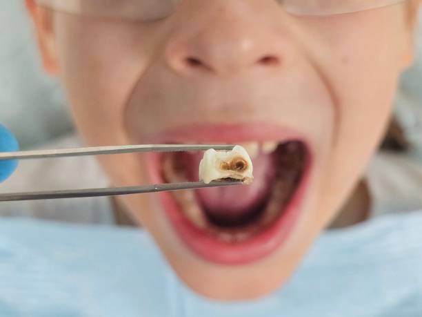 Best Emergency Treatment for Toothache in Hinckley, MN
